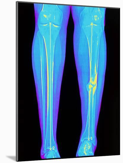 Coloured X-ray of Fractured Shin Bone (tibia)-Mehau Kulyk-Mounted Photographic Print