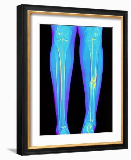 Coloured X-ray of Fractured Shin Bone (tibia)-Mehau Kulyk-Framed Photographic Print