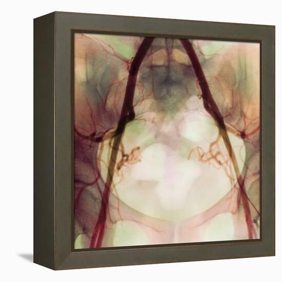 Coloured X-ray of Iliac Arteries To the Pelvis-Science Photo Library-Framed Premier Image Canvas