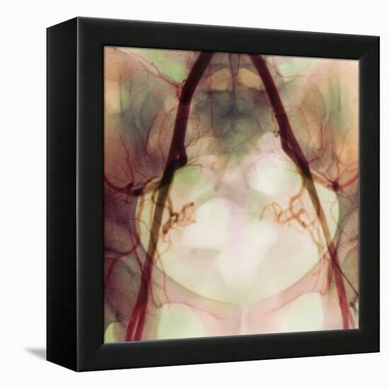 Coloured X-ray of Iliac Arteries To the Pelvis-Science Photo Library-Framed Premier Image Canvas