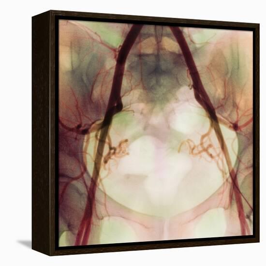 Coloured X-ray of Iliac Arteries To the Pelvis-Science Photo Library-Framed Premier Image Canvas