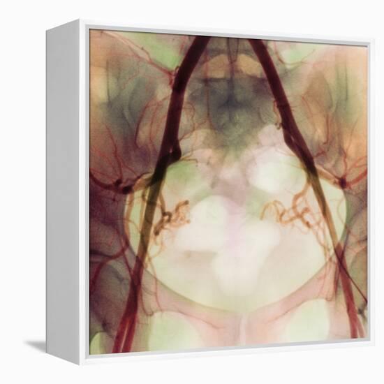 Coloured X-ray of Iliac Arteries To the Pelvis-Science Photo Library-Framed Premier Image Canvas