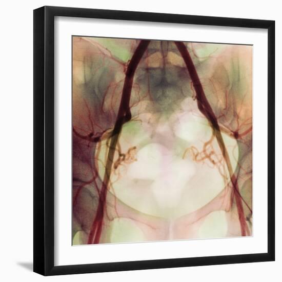 Coloured X-ray of Iliac Arteries To the Pelvis-Science Photo Library-Framed Premium Photographic Print