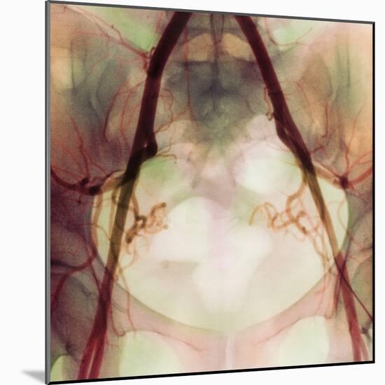 Coloured X-ray of Iliac Arteries To the Pelvis-Science Photo Library-Mounted Premium Photographic Print