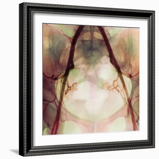 Coloured X-ray of Iliac Arteries To the Pelvis-Science Photo Library-Framed Premium Photographic Print