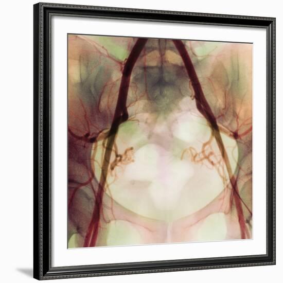 Coloured X-ray of Iliac Arteries To the Pelvis-Science Photo Library-Framed Photographic Print