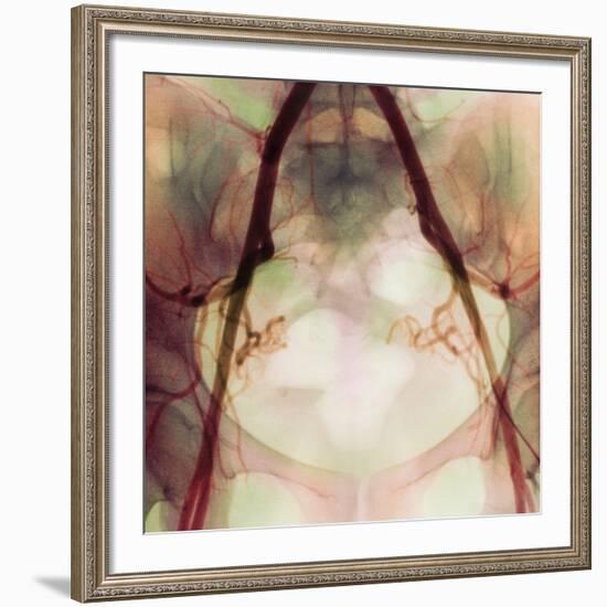 Coloured X-ray of Iliac Arteries To the Pelvis-Science Photo Library-Framed Photographic Print