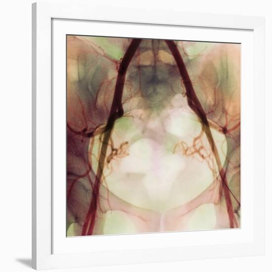 Coloured X-ray of Iliac Arteries To the Pelvis-Science Photo Library-Framed Photographic Print