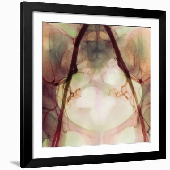 Coloured X-ray of Iliac Arteries To the Pelvis-Science Photo Library-Framed Photographic Print