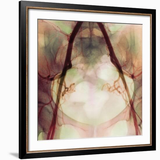 Coloured X-ray of Iliac Arteries To the Pelvis-Science Photo Library-Framed Photographic Print