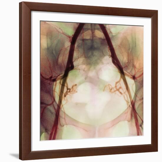 Coloured X-ray of Iliac Arteries To the Pelvis-Science Photo Library-Framed Photographic Print