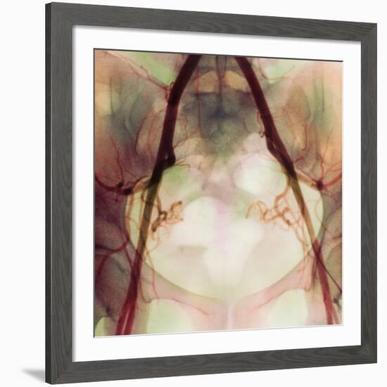 Coloured X-ray of Iliac Arteries To the Pelvis-Science Photo Library-Framed Photographic Print