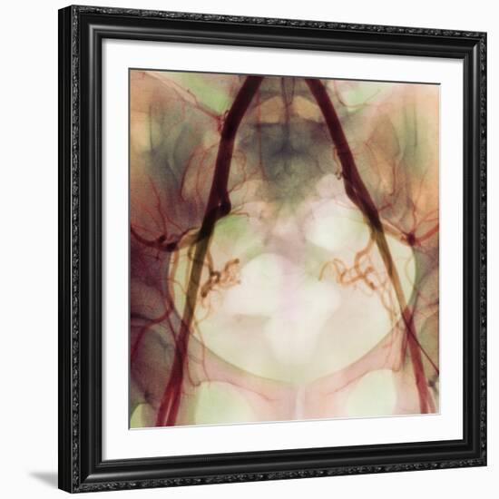 Coloured X-ray of Iliac Arteries To the Pelvis-Science Photo Library-Framed Photographic Print
