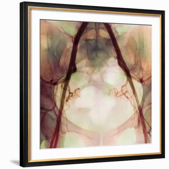 Coloured X-ray of Iliac Arteries To the Pelvis-Science Photo Library-Framed Photographic Print
