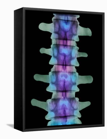 Coloured X-ray of Lumbar Vertebrae of the Spine-Science Photo Library-Framed Premier Image Canvas