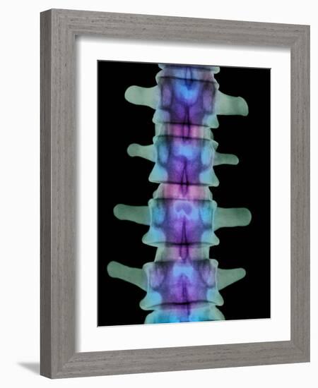 Coloured X-ray of Lumbar Vertebrae of the Spine-Science Photo Library-Framed Photographic Print