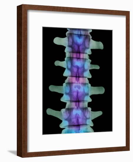 Coloured X-ray of Lumbar Vertebrae of the Spine-Science Photo Library-Framed Photographic Print