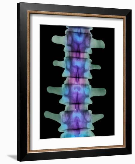 Coloured X-ray of Lumbar Vertebrae of the Spine-Science Photo Library-Framed Photographic Print