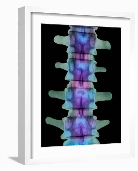 Coloured X-ray of Lumbar Vertebrae of the Spine-Science Photo Library-Framed Photographic Print