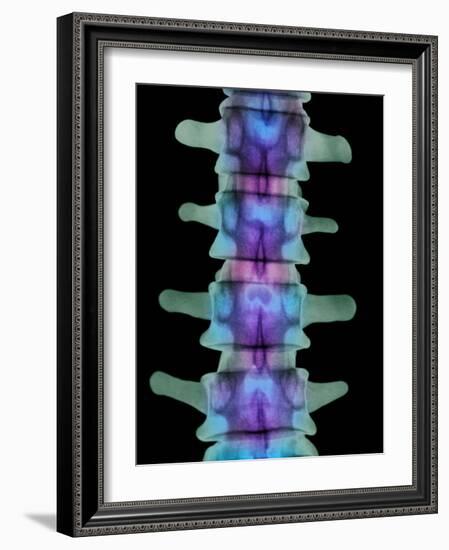 Coloured X-ray of Lumbar Vertebrae of the Spine-Science Photo Library-Framed Photographic Print