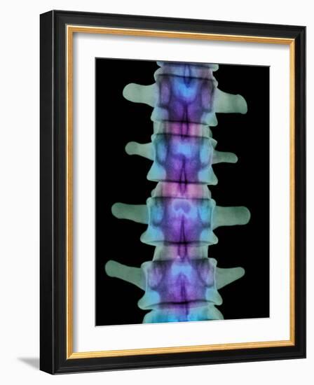 Coloured X-ray of Lumbar Vertebrae of the Spine-Science Photo Library-Framed Photographic Print