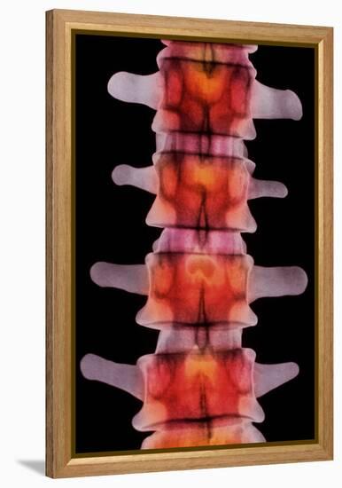 Coloured X-ray of Lumbar Vertebrae of The-Science Photo Library-Framed Premier Image Canvas