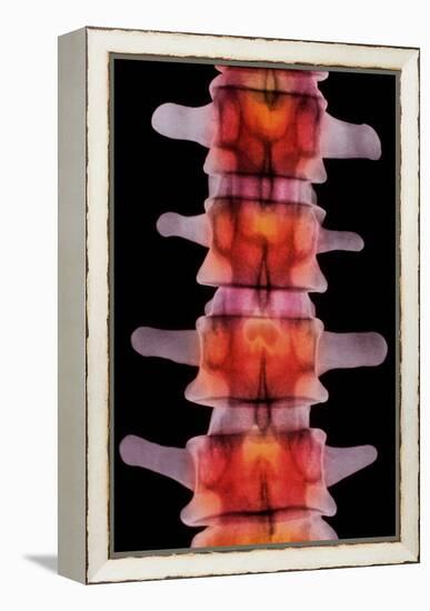 Coloured X-ray of Lumbar Vertebrae of The-Science Photo Library-Framed Premier Image Canvas
