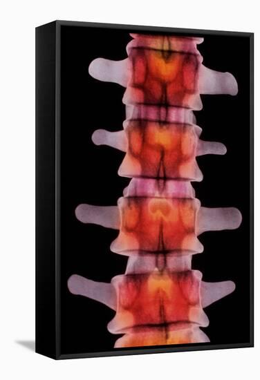 Coloured X-ray of Lumbar Vertebrae of The-Science Photo Library-Framed Premier Image Canvas