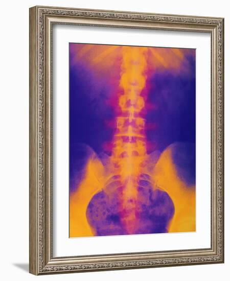 Coloured X-ray of Normal Lower Spine And Pelvis-Mehau Kulyk-Framed Photographic Print