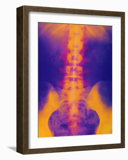 Coloured X-ray of Normal Lower Spine And Pelvis-Mehau Kulyk-Framed Photographic Print