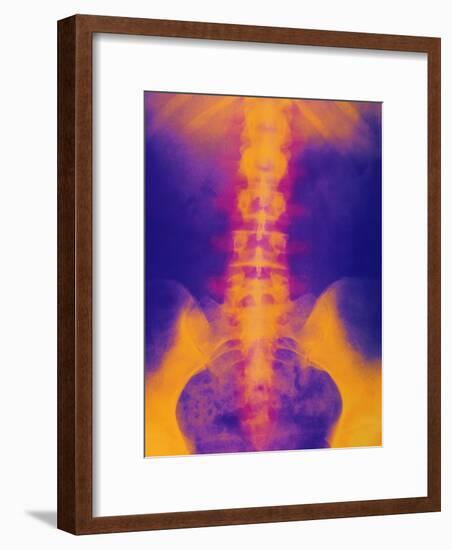 Coloured X-ray of Normal Lower Spine And Pelvis-Mehau Kulyk-Framed Photographic Print