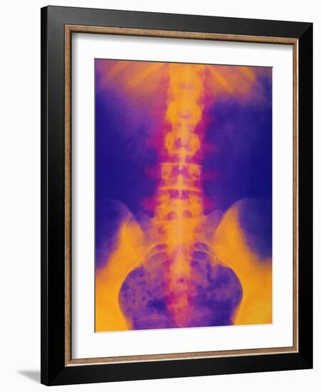 Coloured X-ray of Normal Lower Spine And Pelvis-Mehau Kulyk-Framed Photographic Print