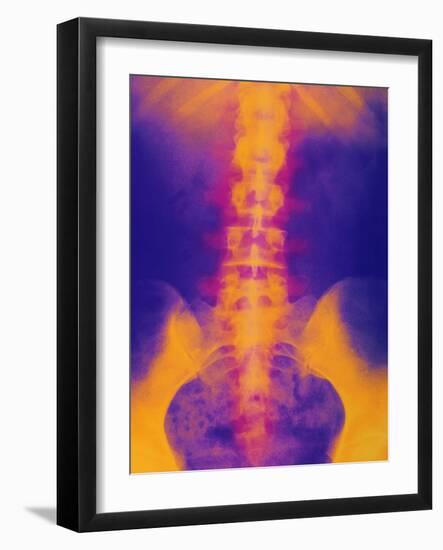 Coloured X-ray of Normal Lower Spine And Pelvis-Mehau Kulyk-Framed Photographic Print