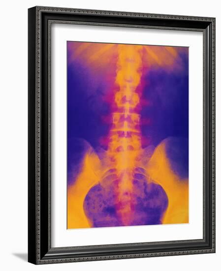 Coloured X-ray of Normal Lower Spine And Pelvis-Mehau Kulyk-Framed Photographic Print