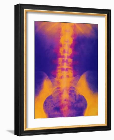 Coloured X-ray of Normal Lower Spine And Pelvis-Mehau Kulyk-Framed Photographic Print