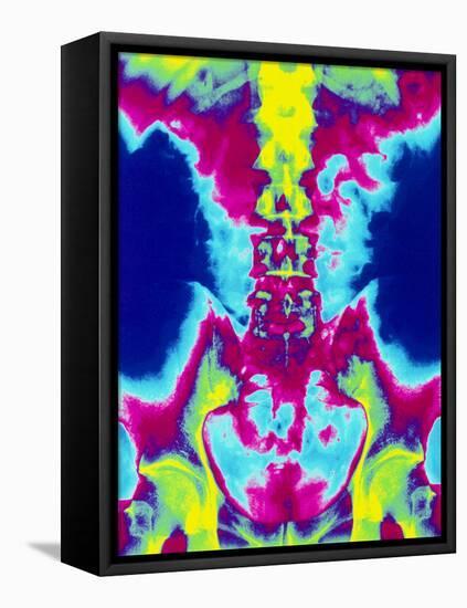 Coloured X-ray of Normal Lumbar Spine (lower Back)-Mehau Kulyk-Framed Premier Image Canvas