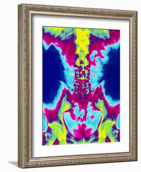 Coloured X-ray of Normal Lumbar Spine (lower Back)-Mehau Kulyk-Framed Photographic Print