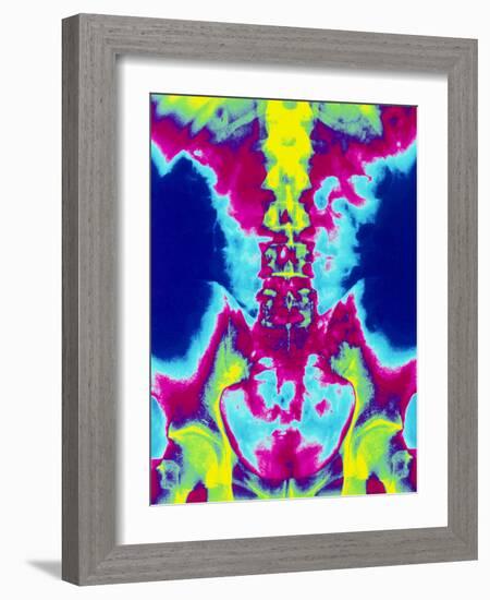 Coloured X-ray of Normal Lumbar Spine (lower Back)-Mehau Kulyk-Framed Photographic Print