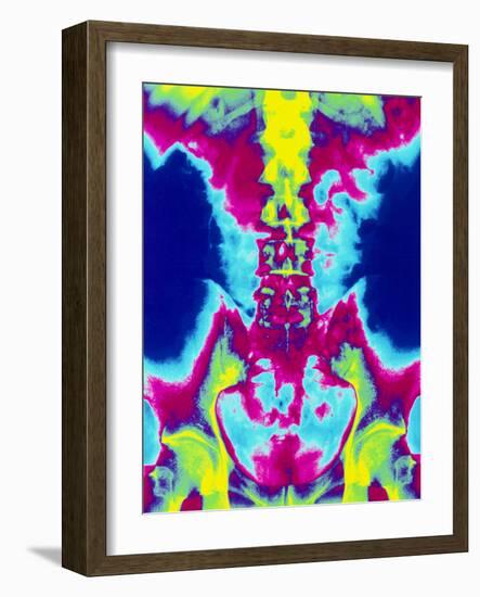 Coloured X-ray of Normal Lumbar Spine (lower Back)-Mehau Kulyk-Framed Photographic Print