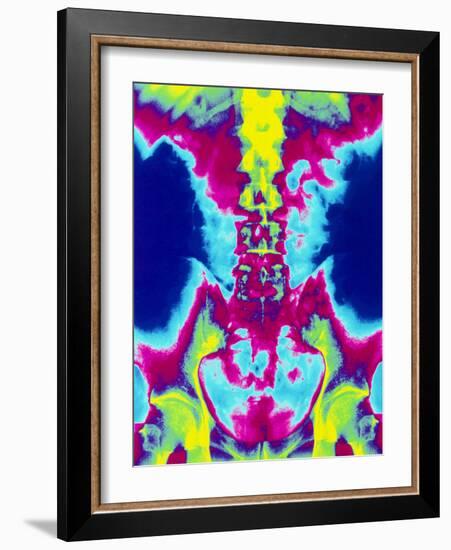 Coloured X-ray of Normal Lumbar Spine (lower Back)-Mehau Kulyk-Framed Photographic Print