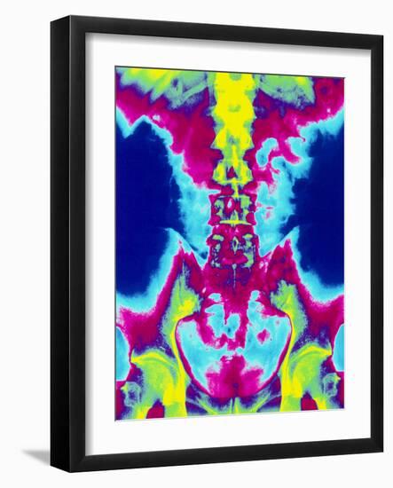 Coloured X-ray of Normal Lumbar Spine (lower Back)-Mehau Kulyk-Framed Photographic Print