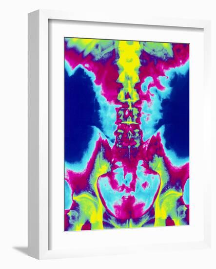 Coloured X-ray of Normal Lumbar Spine (lower Back)-Mehau Kulyk-Framed Photographic Print