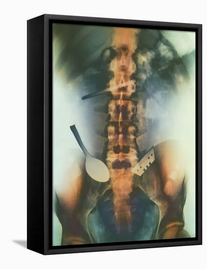 Coloured X-ray of Spoon And Blade In Intestine-Science Photo Library-Framed Premier Image Canvas