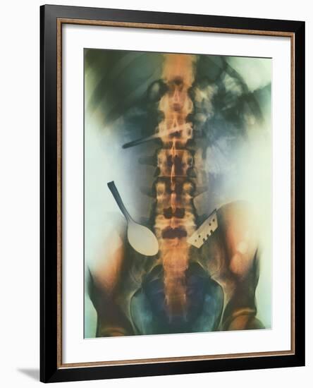 Coloured X-ray of Spoon And Blade In Intestine-Science Photo Library-Framed Photographic Print