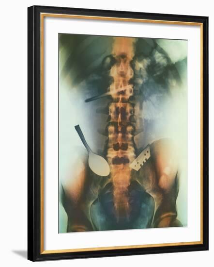 Coloured X-ray of Spoon And Blade In Intestine-Science Photo Library-Framed Photographic Print