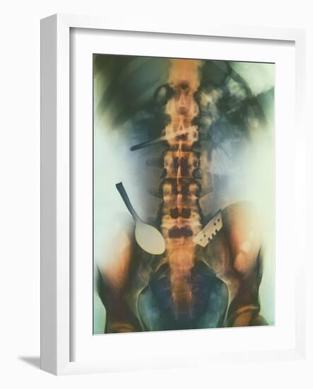 Coloured X-ray of Spoon And Blade In Intestine-Science Photo Library-Framed Photographic Print