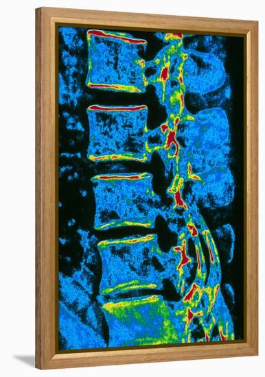 Coloured X-ray of Vertebrae with Osteoporosis-PASIEKA-Framed Premier Image Canvas