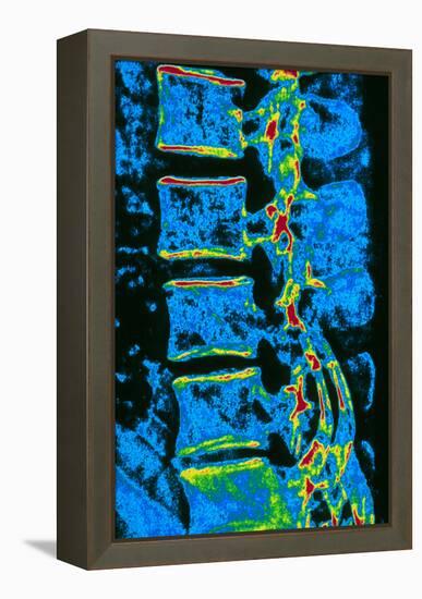 Coloured X-ray of Vertebrae with Osteoporosis-PASIEKA-Framed Premier Image Canvas