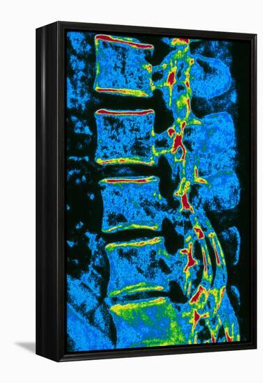 Coloured X-ray of Vertebrae with Osteoporosis-PASIEKA-Framed Premier Image Canvas