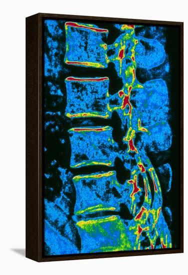 Coloured X-ray of Vertebrae with Osteoporosis-PASIEKA-Framed Premier Image Canvas